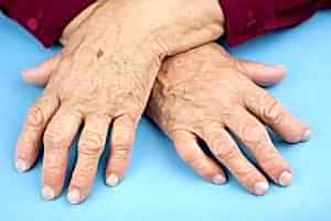 артрит у пожилых